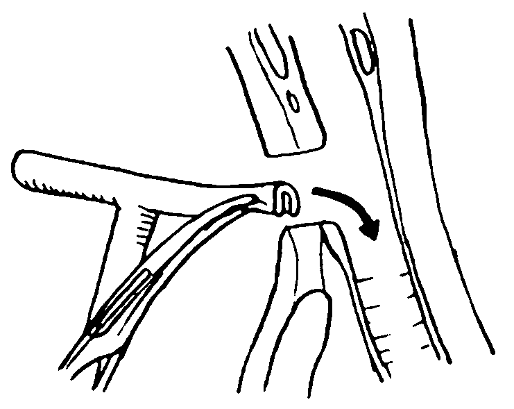 لوله تراشه حنجره تی تیوب Tracheal T-Tube لوله تراشه حنجره تی تیوب Tracheal T-Tube