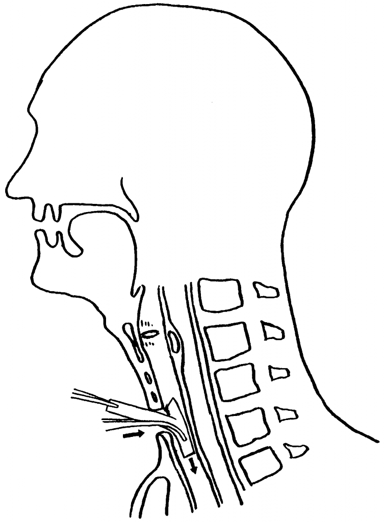 لوله تراشه حنجره تی تیوب Tracheal T-Tube لوله تراشه حنجره تی تیوب Tracheal T-Tube