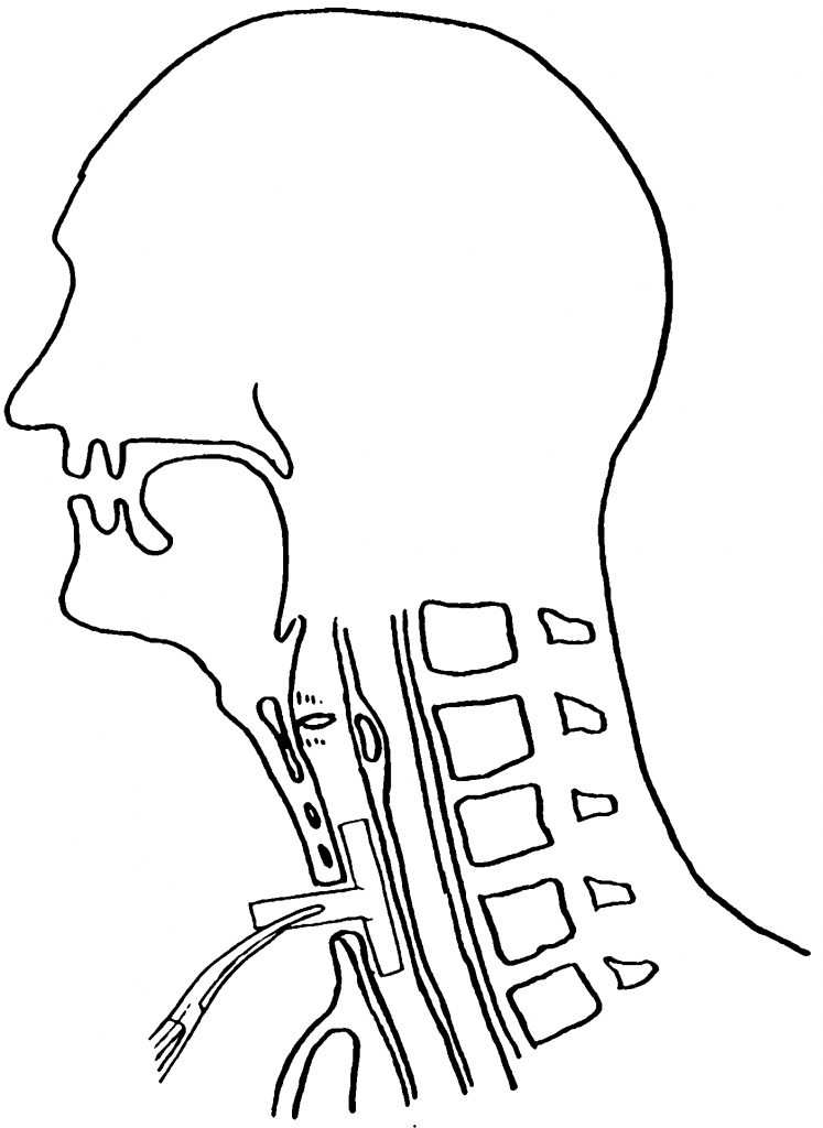 لوله تراشه حنجره تی تیوب Tracheal T-Tube لوله تراشه حنجره تی تیوب Tracheal T-Tube