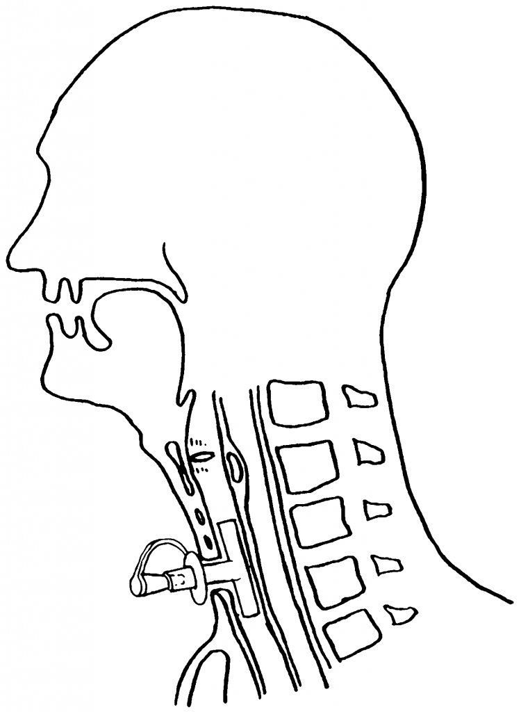 لوله تراشه حنجره تی تیوب Tracheal T-Tube لوله تراشه حنجره تی تیوب Tracheal T-Tube