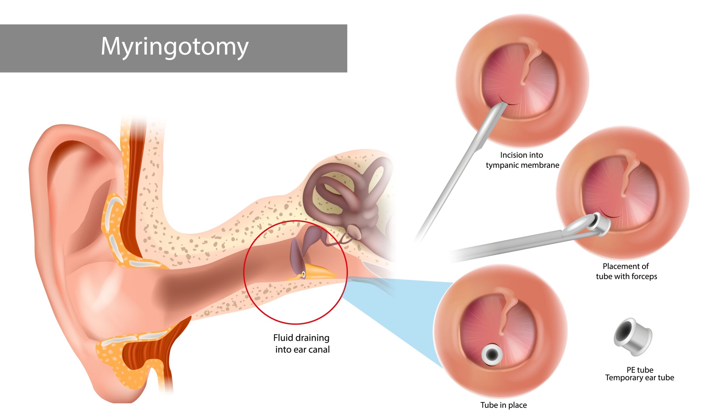 لوله تی تیوب گوش Ventilation T-Tube لوله تی تیوب گوش Ventilation T-Tube