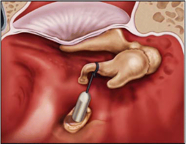 ایمپلنت گوش میانی تفلون وایر Teflon Wire Middle Ear Implant ایمپلنت گوش میانی تفلون وایر Teflon Wire Middle Ear Implant