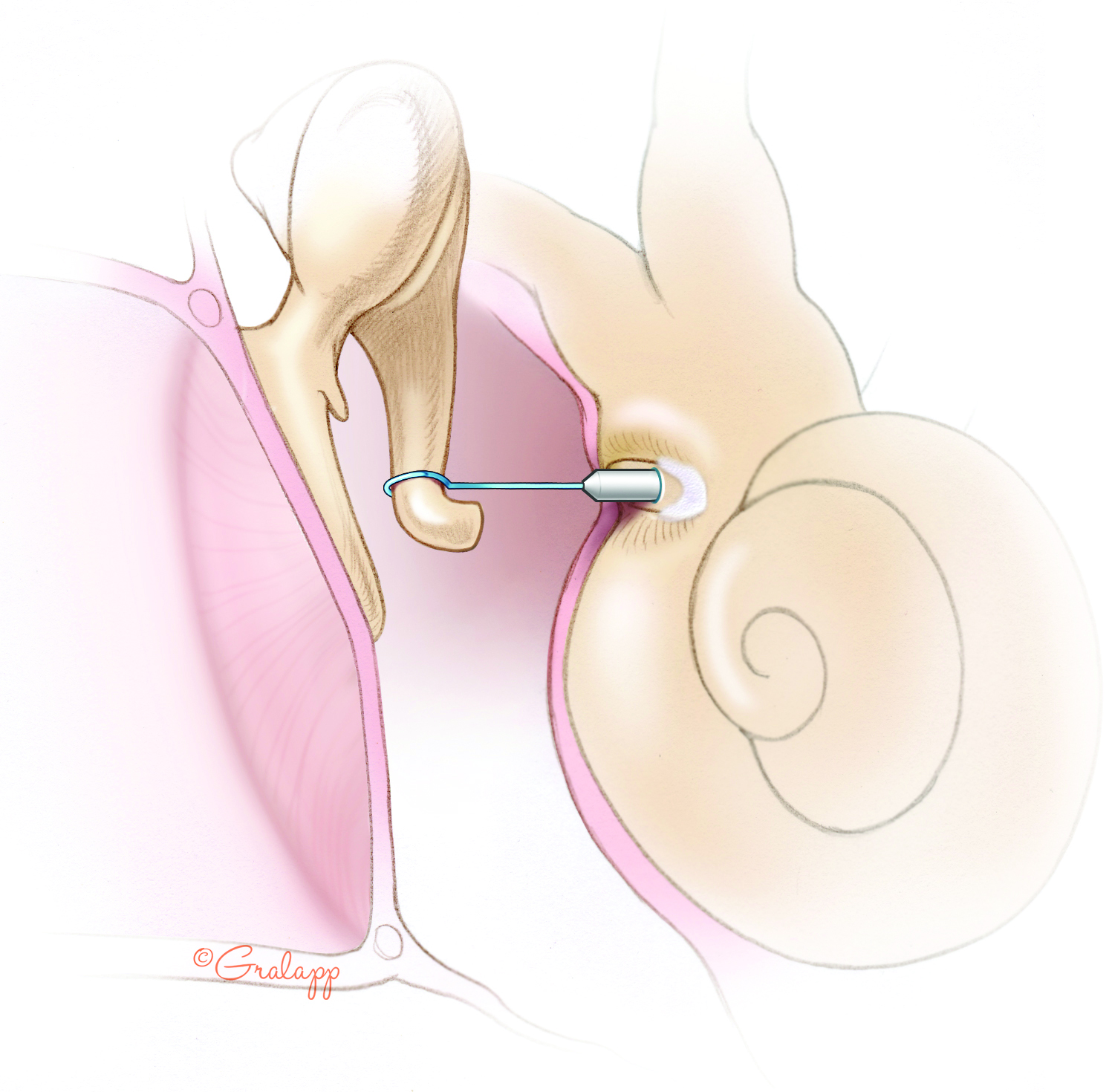 ایمپلنت گوش میانی تفلون پیستون Teflon Piston Middle Ear Implant ایمپلنت گوش میانی تفلون پیستون Teflon Piston Middle Ear Implant