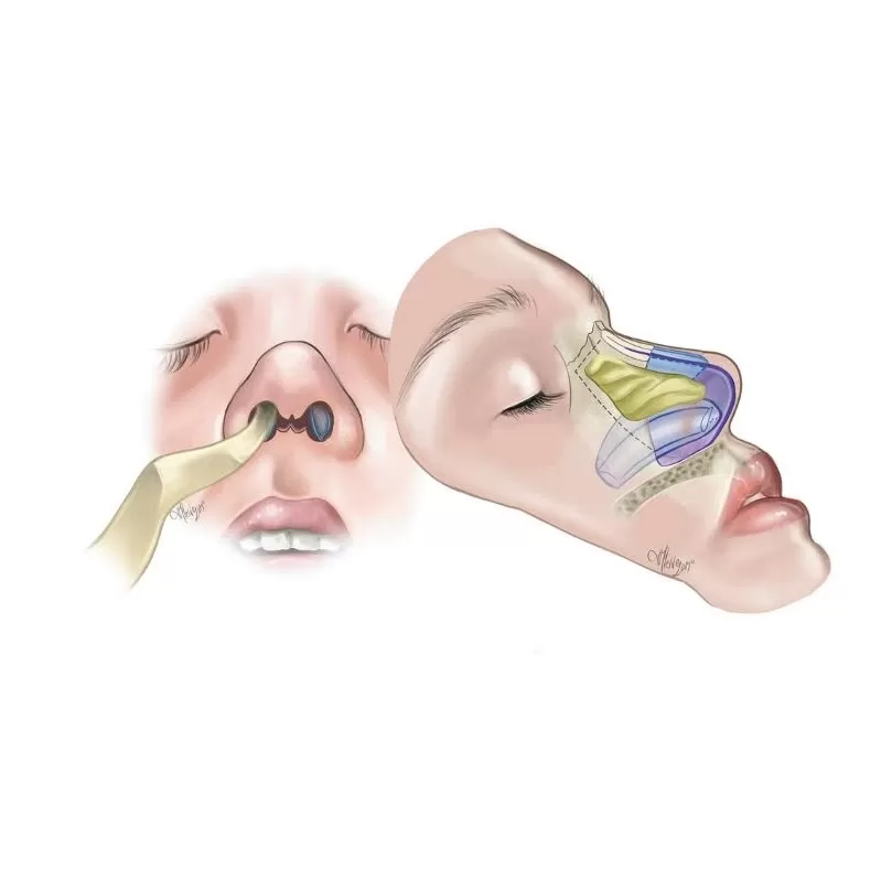 اسپلینت راه هوایی داخل بینی Internal Nasal Airway Splint اسپلینت راه هوایی داخل بینی Internal Nasal Airway Splint