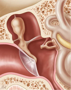 پروتز استخوانچه گوش میانی پورپ Porp Middle Ear Prosthesis پروتز استخوانچه گوش میانی پورپ Porp Middle Ear Prosthesis
