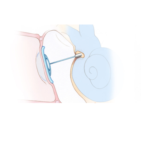 پروتز استخوانچه گوش میانی تورپ Torp Middle Ear Prosthesis پروتز استخوانچه گوش میانی تورپ Torp Middle Ear Prosthesis