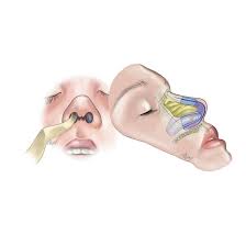 مش داخل بینی Internal Nasal Mesh محصولات و تجهیزات جراحی بینی